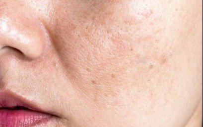 Reduces Appearance of pores
